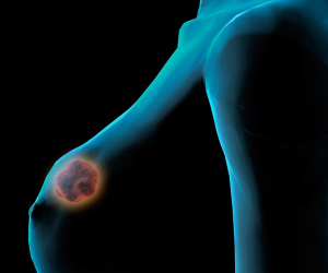 Dal 2018 si sperimenta vaccino contro tumore al seno